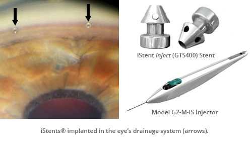 iStent® Trabecular Micro-bypass